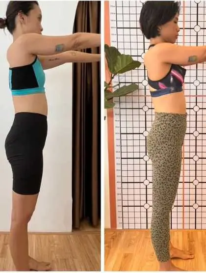 Before spinal correction