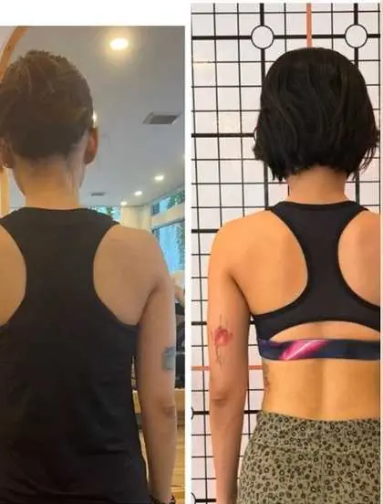 Before shoulder symmetry